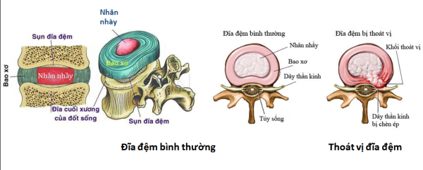 Hình ảnh đĩa đệm