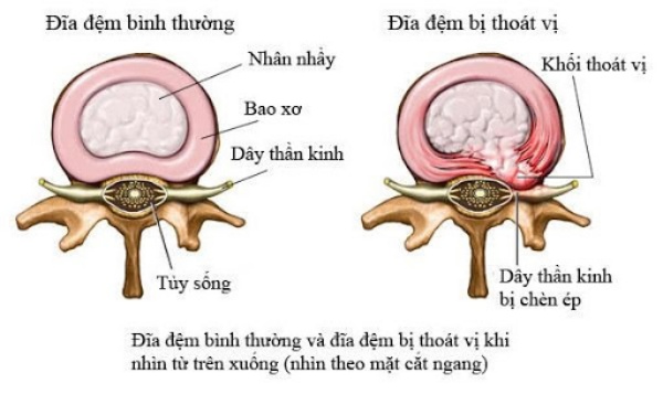 Hình ảnh địa đệm bị thoát vị