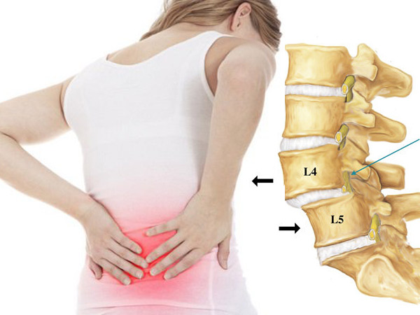 ĐẶC ĐIỂM LÂM SÀNG, CẬN LÂM SÀNG CỦA BỆNH LÝ TRƯỢT ĐỐT SỐNG THẮT LƯNG CÙNG CÓ CHỈ ĐỊNH PHẪU THUẬT TRÊN BỆNH NHÂN ĐÁI THÁO ĐƯỜNG