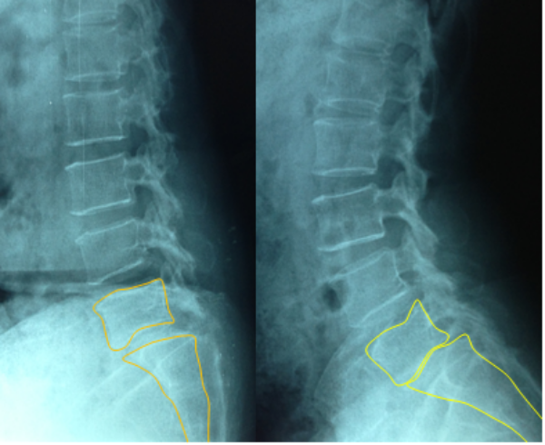 Hình ảnh đốt sống thắt lưng bị trượt