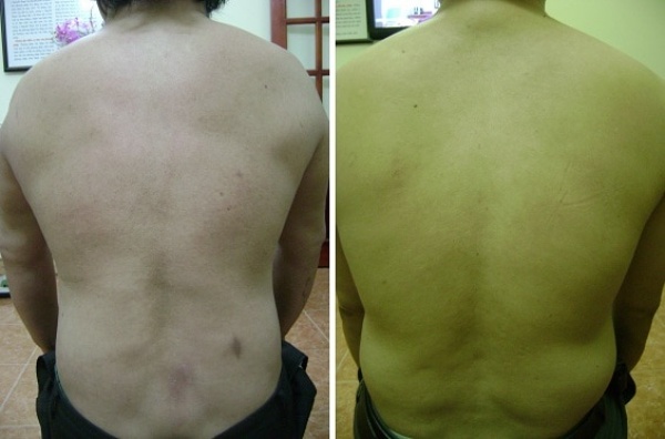 Hình ảnh bệnh nhân trượt đốt sống thắt lưng