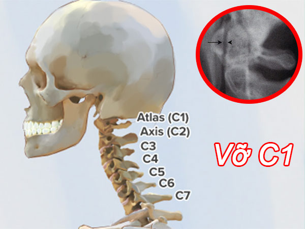 Tiếp cận chẩn đoán và điều trị vỡ C1