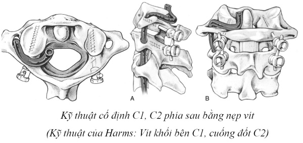 kỹ thuật Goel – Harm để cố định C1 C2