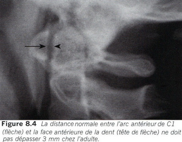 Hình ảnh Xquang vỡ C1