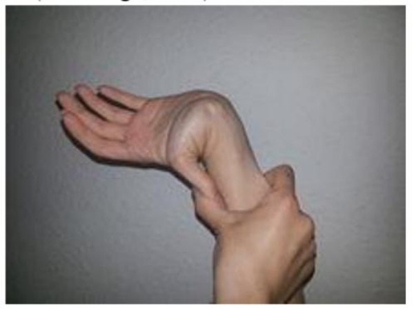 Hình 3: Hiện tượng lỏng khớp quá mức