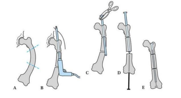 Kĩ thuật cắt xương chỉnh trục và đóng đinh (đinh Fassier-Duval) mổ mở