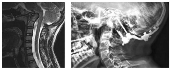Hình 7: (A) Cộng hưởng từ cột sống cổ thì T2 cho thấy chèn ép nền sọ tiến triển của trẻ 14 tuổi OI. BN có biểu hiện đau đầu, đau cổ, không giảm, không có thiếu sót về vận động và ciarm giác tứ chi. (B) Hình ảnh sau mổ giải ép, nẹp vít cổ chẩm của cùng bệnh nhân.