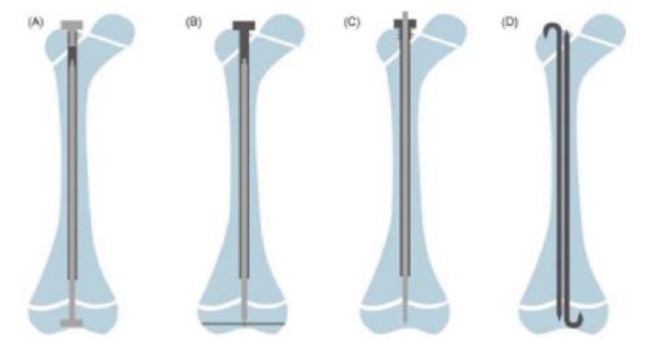 Dụng cụ thường dùng khi cắt xương chỉnh trục và đặt đinh nội tủy