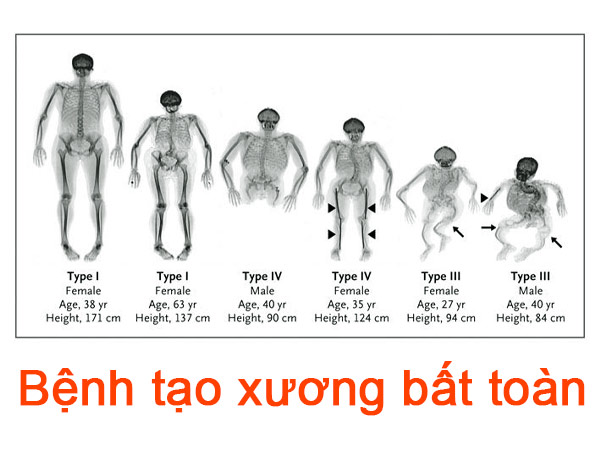 Bệnh tạo xương bất toàn