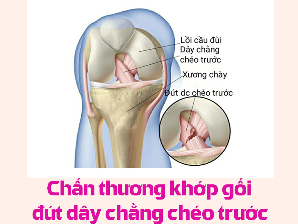 Chấn thương khớp gối đứt dây chằng chéo trước
