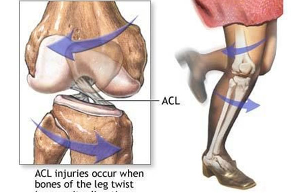 Dây chằng chéo trước