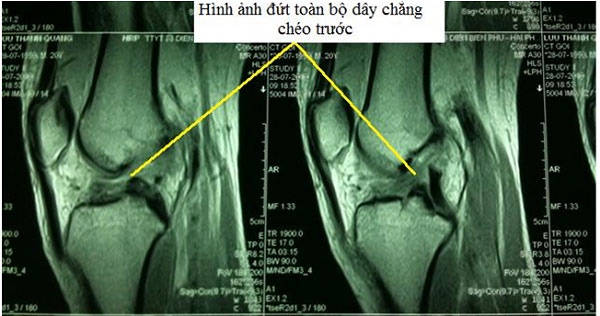 Hình ảnh đứt toàn bộ dây chằng chéo trước
