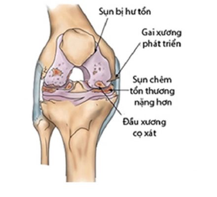 Ảnh hưởng của khớp gối khi không mổ