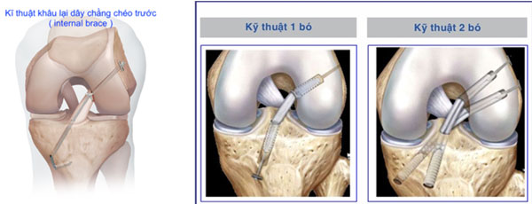 Kỹ thuật mổ đứt chằng chéo trước thường được sử dụng