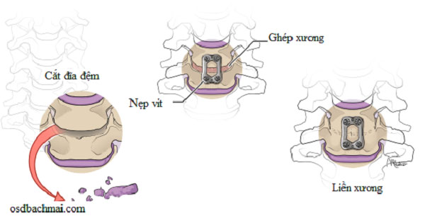 Phẫu thuật cắt bỏ đĩa đệm và kết hợp xương cột sống cổ lối trước