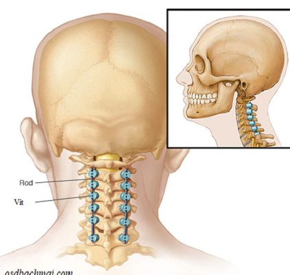 Phẫu thuật cố định cột sống cổ lối sau