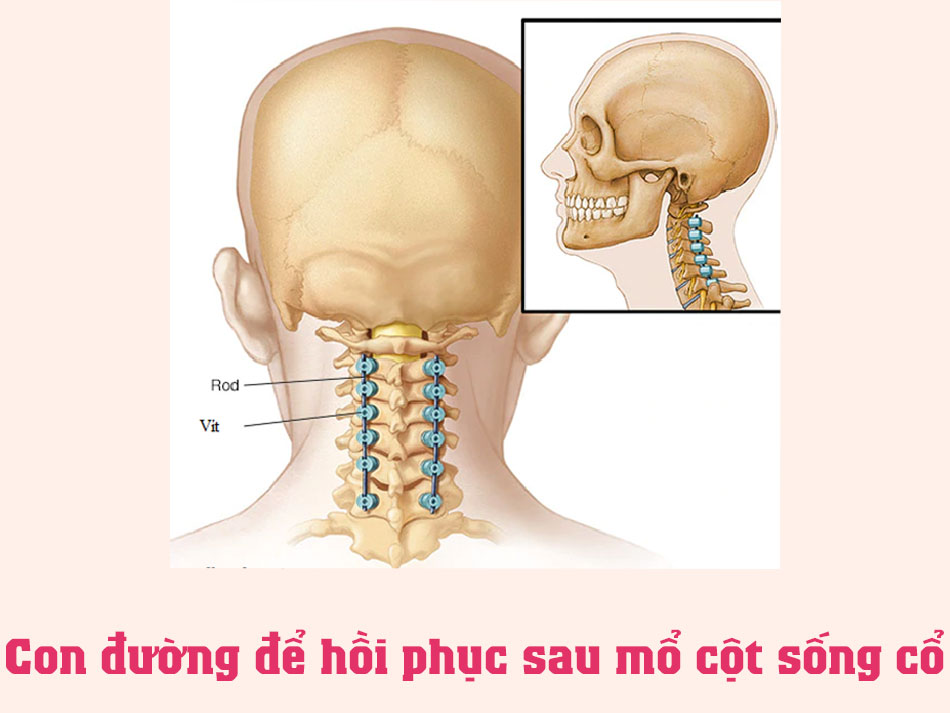 Con đường để hồi phục sau mổ cột sống cổ