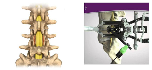 Phẫu thuật cắt bỏ cung sau (bên trái) và phẫu thuật XLIF (bên phải)