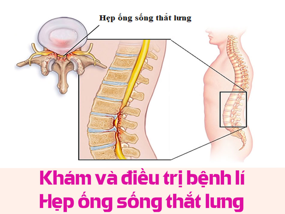 Khám và điều trị bệnh lí Hẹp ống sống thắt lưng