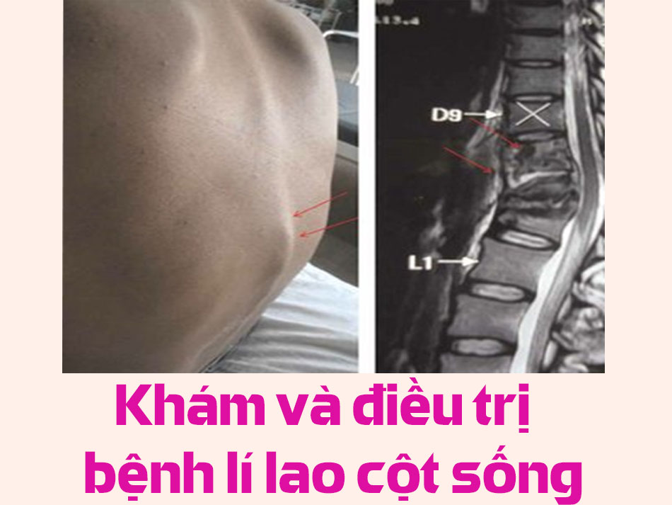 Khám và điều trị bệnh lí lao cột sống