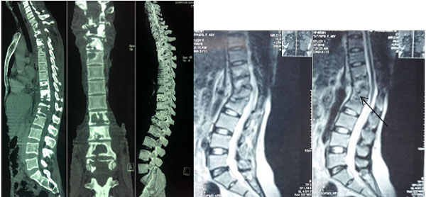 Hình ảnh cắt lớp vi tính (bên trái) và cộng hưởng từ (bên phải) trong lao cột sống
