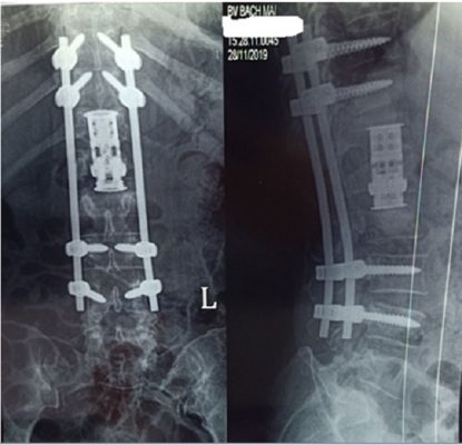 Cố định cột sống và thay thân đốt sống nhân tạo tổn thương lao T12L1L2