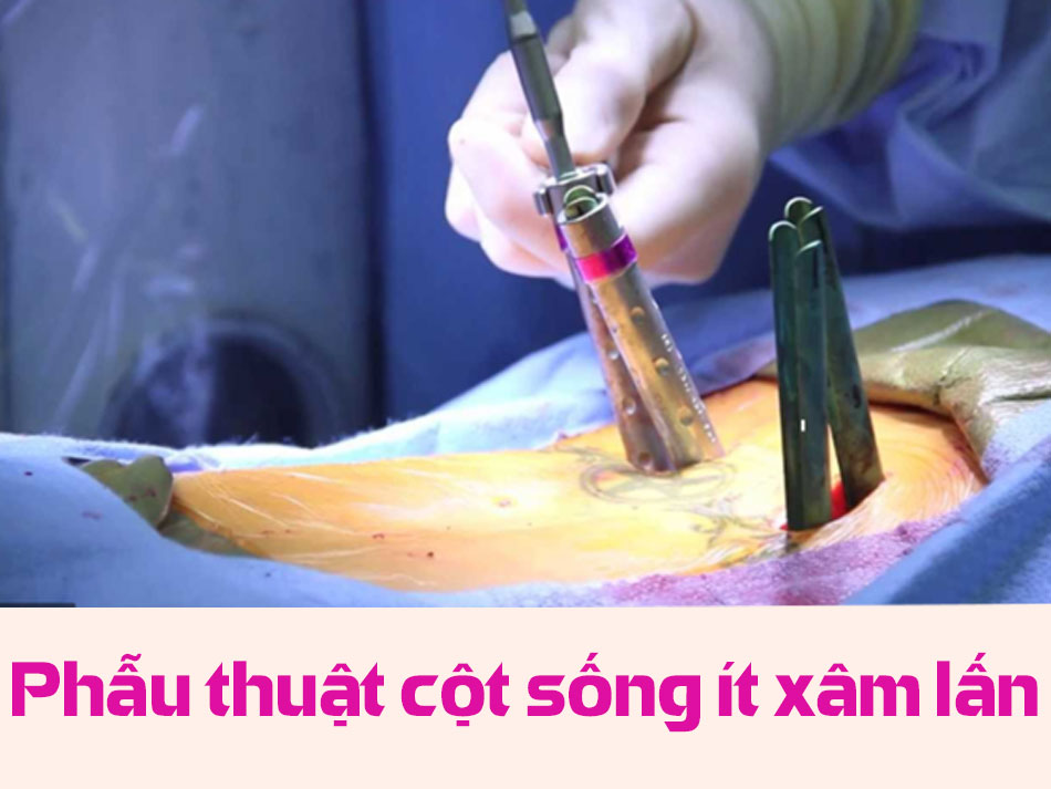 Phẫu thuật cột sống ít xâm lấn