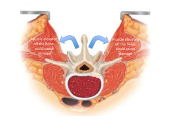 Phẫu thuật mổ mở truyền thống