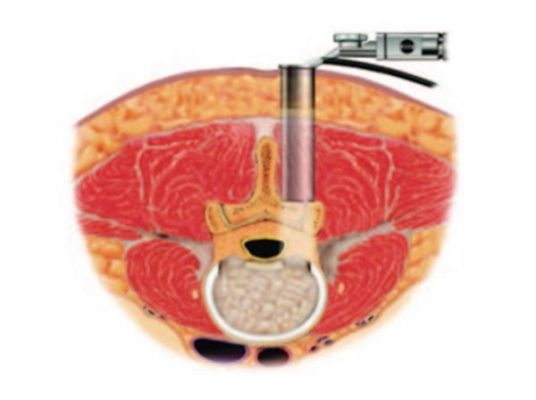 Phẫu thuật ít xâm lấn qua hệ thống ống nong