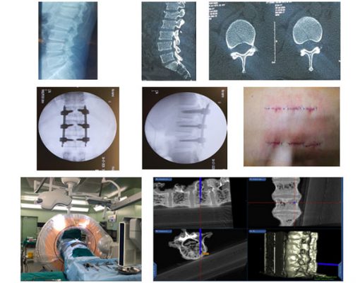 Cố định cột sống sử dụng vít qua da có hệ thống O.arm