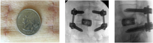 Phẫu thuật trượt đốt sống thắt lưng cùng ít xâm lấn (MIS-TLIF)