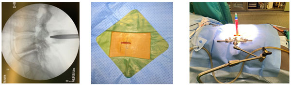 Phẫu thuật lấy thoát vị đĩa đệm qua hệ thống ống nong