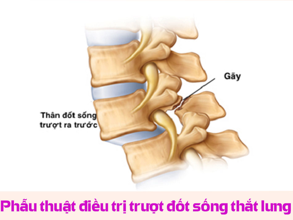 Phẫu thuật điều trị trượt đốt sống thắt lưng