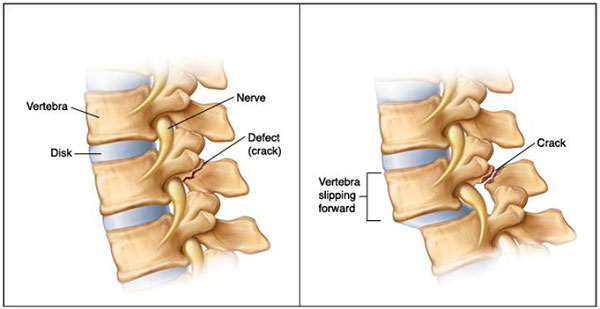 Đốt sống bình thường và Trượt đốt sống