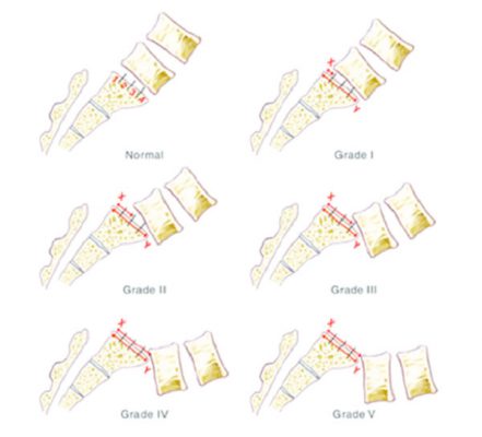Phân loại mức độ trượt đốt sống (Meyerding)