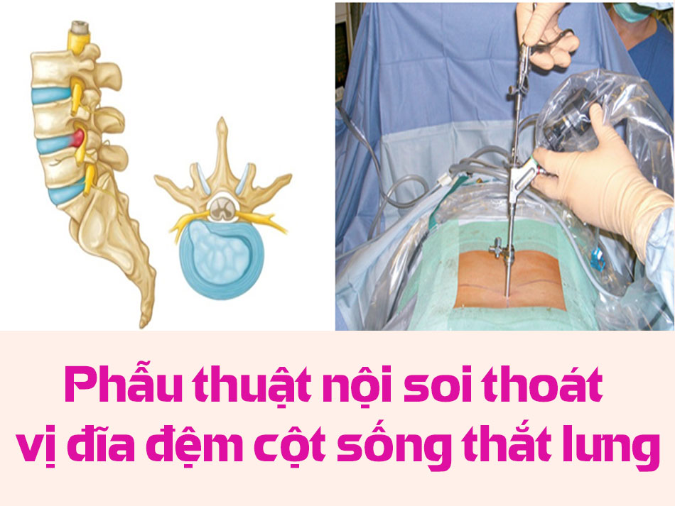 Phẫu thuật nội soi thoát vị đĩa đệm cột sống thắt lưng