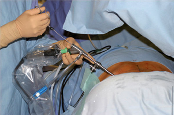 Phẫu thuật nội soi lấy thoát vị đĩa đệm cột sống thắt lưng qua lỗ liên hợp