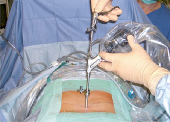 Phẫu thuật nội soi lấy thoát vị đĩa đệm cột sống thắt lưng qua liên bản sống