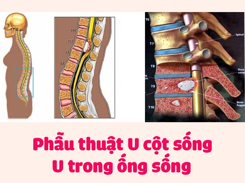 Phẫu thuật U cột sống - U trong ống sống
