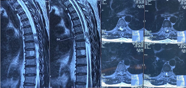 Điều trị U cột sống như thế nào?