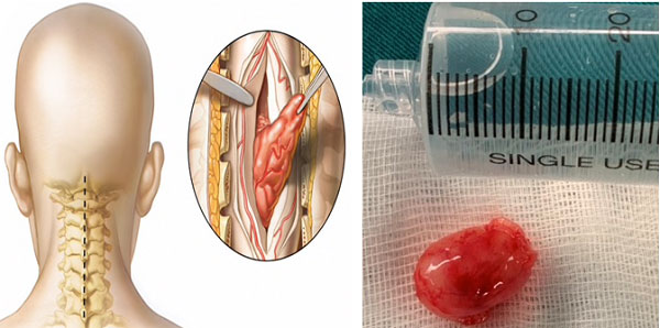 Phẫu thuật lấy u tuỷ sống cột sống cổ