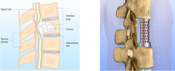 U tế bào khổng lồ than đốt sống và phẫu thuật thay thân đốt sống