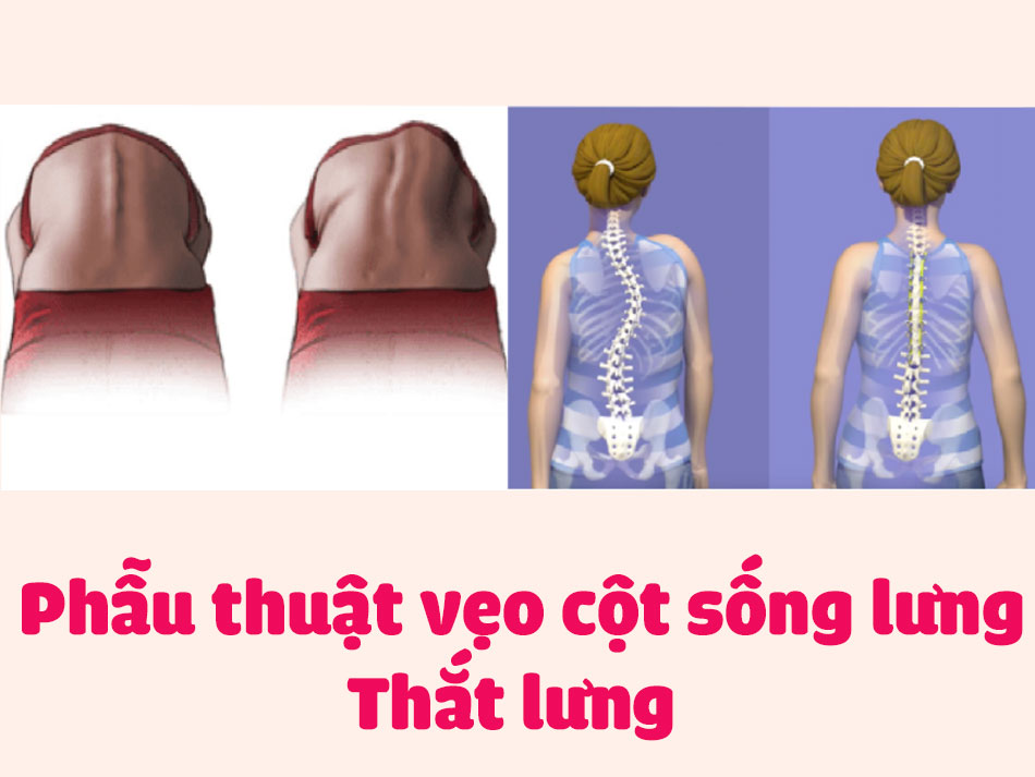 Phẫu thuật vẹo cột sống lưng - Thắt lưng