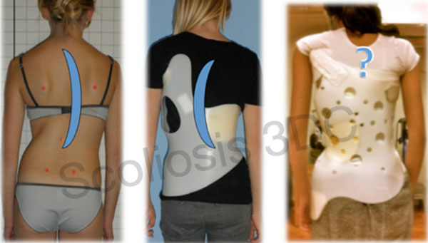 Đeo áo nẹp nắn chỉnh vẹo cột sống