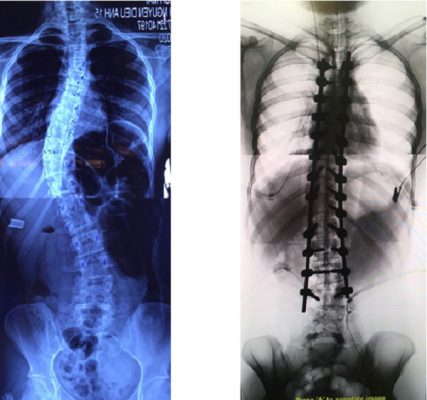 Hình ảnh phẫu thuật chỉnh vẹo trước và sau phẫu thuật