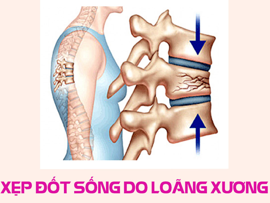 Xẹp đốt sống do loãng xương