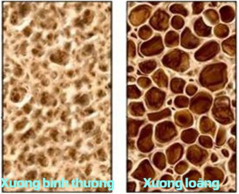 Dấu hiệu nhận biết loãng xương