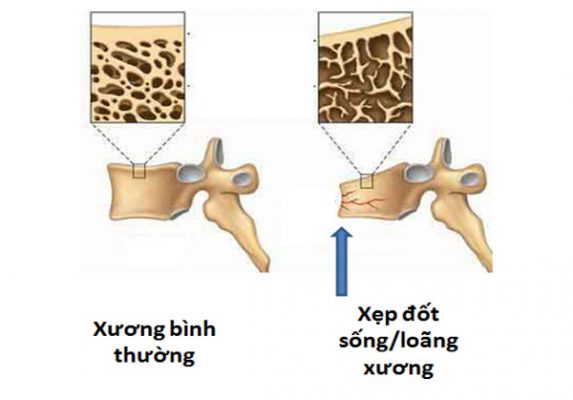 Biểu hiện Xẹp đốt sống do loãng xương