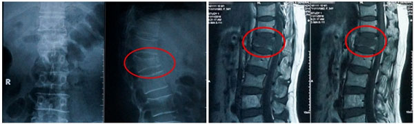 Hình ảnh xẹp đốt sống L1 trên X-quang và MRI