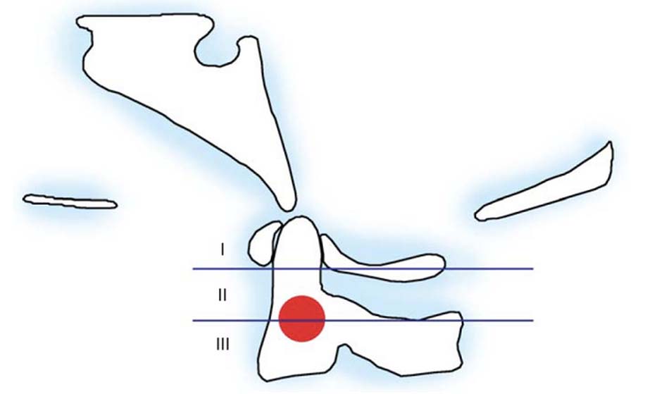 Tiêu chuẩn Clark trong đánh giá tật lồng đáy sọ